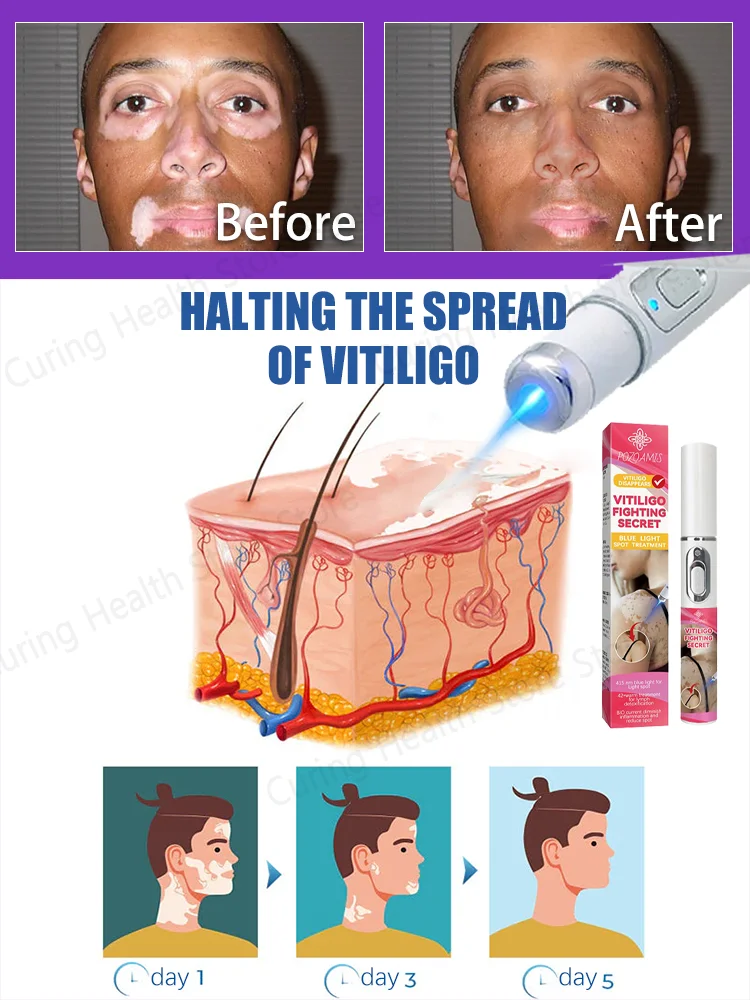 laser vitiligo