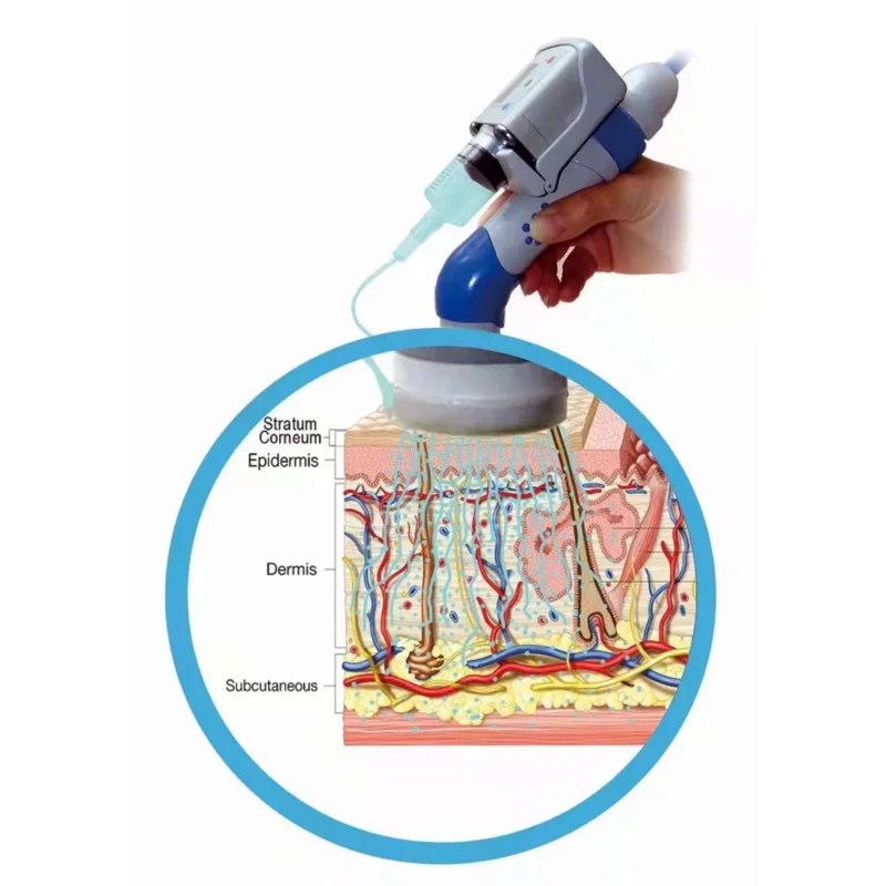 Dep Mesotherapie Waterinjectie Mesogun Dermoelektroporation