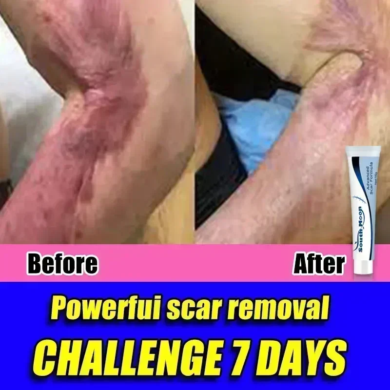 

NewScar Removal Cream Old Scar Cream Effective Repair New Scars Surgical Scars Stretch Marks Acne Pits Acne Marks Burn Scars090