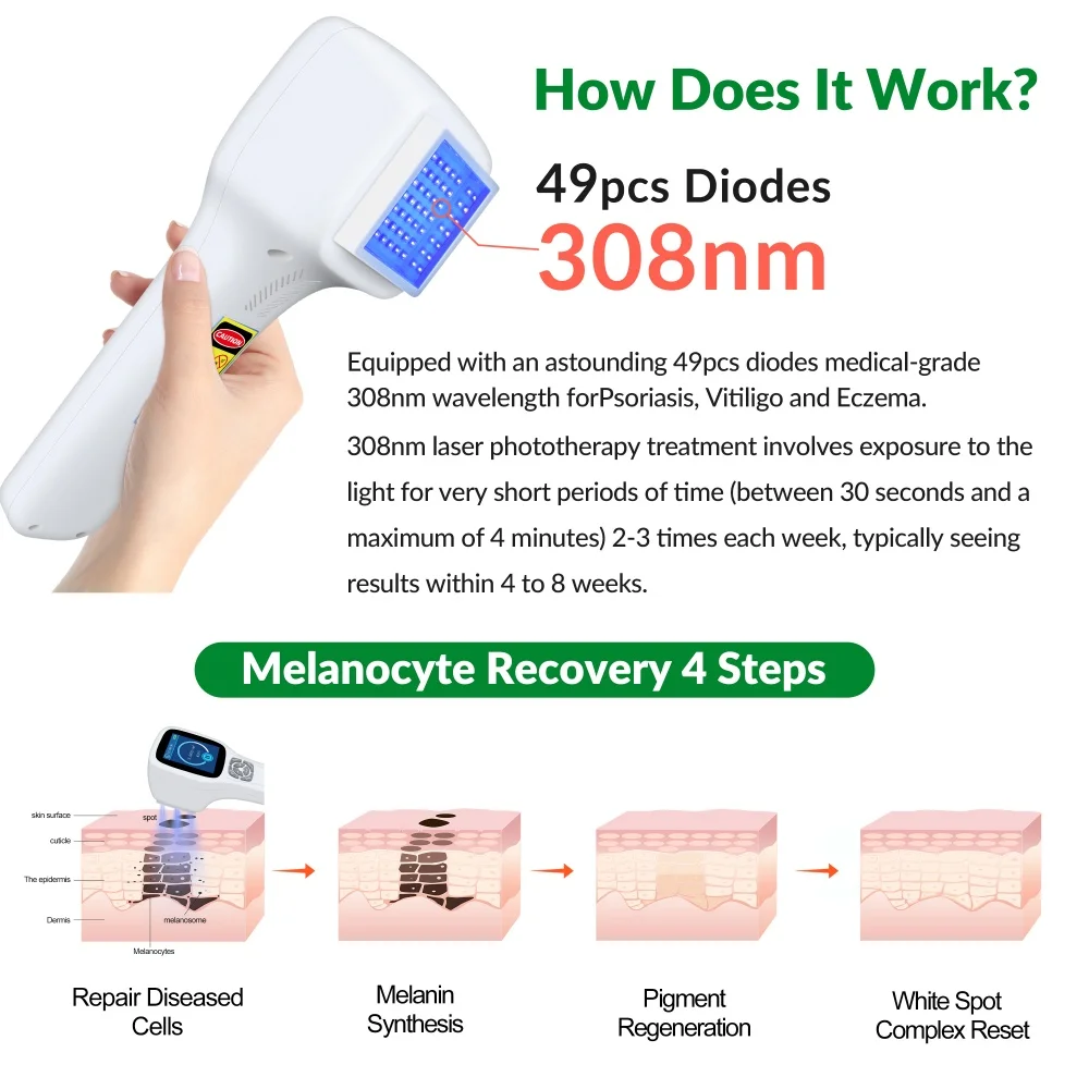 Frovab Handheld Excimer Ultraviolet Light Therapy Device for Vitiligo Psoriasis Eczema Skin Spot UVB Phototherapy Treatment