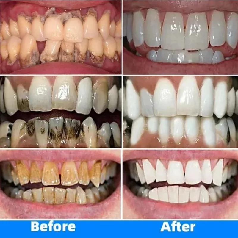 Useful Toothpaste Prevent Repair Tooth Decay Remove Plaque Whiten Teeth Relieve Periodontitis Toothache Freshen Bad Breath