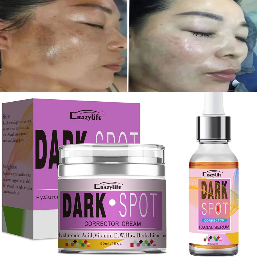 50ml Powerful Whitening Freckle Cream Remove Acne Spots Melanin Dark Spots Face Lift Firming Face Skin Care Beauty Essentials