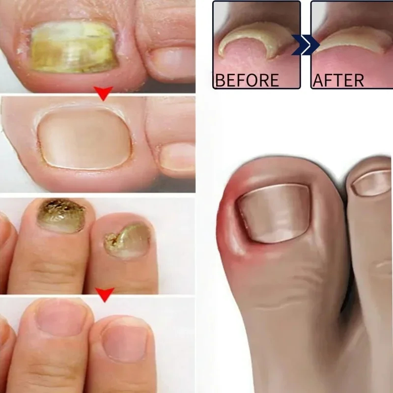 Gouttes de réparation fongique des ongles, élimination des ongles, Anti-Paronychia, améliore les ongles cassés, craquelés et décolorés, Essence de soin pour renouvellement des ongles