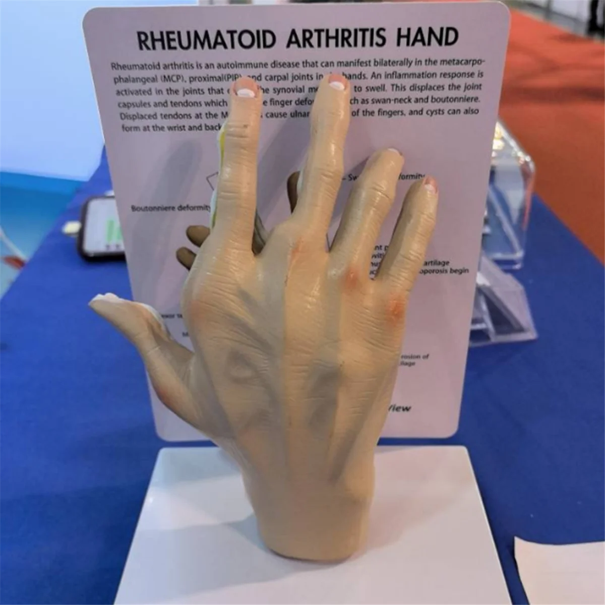 Arthrose-Handmodell, Handpathologie-Modell, Nachbildung der menschlichen Anatomie und Physiologie, Anatomiemodell des Arztbüros