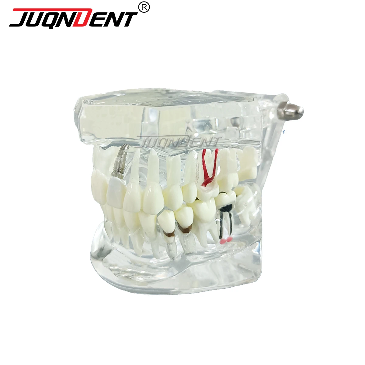 Dental Implant Restoration Teeth Model With Removable Tooth Demo Disease Post Core Crown Veneer Bridge Teaching Demonstration