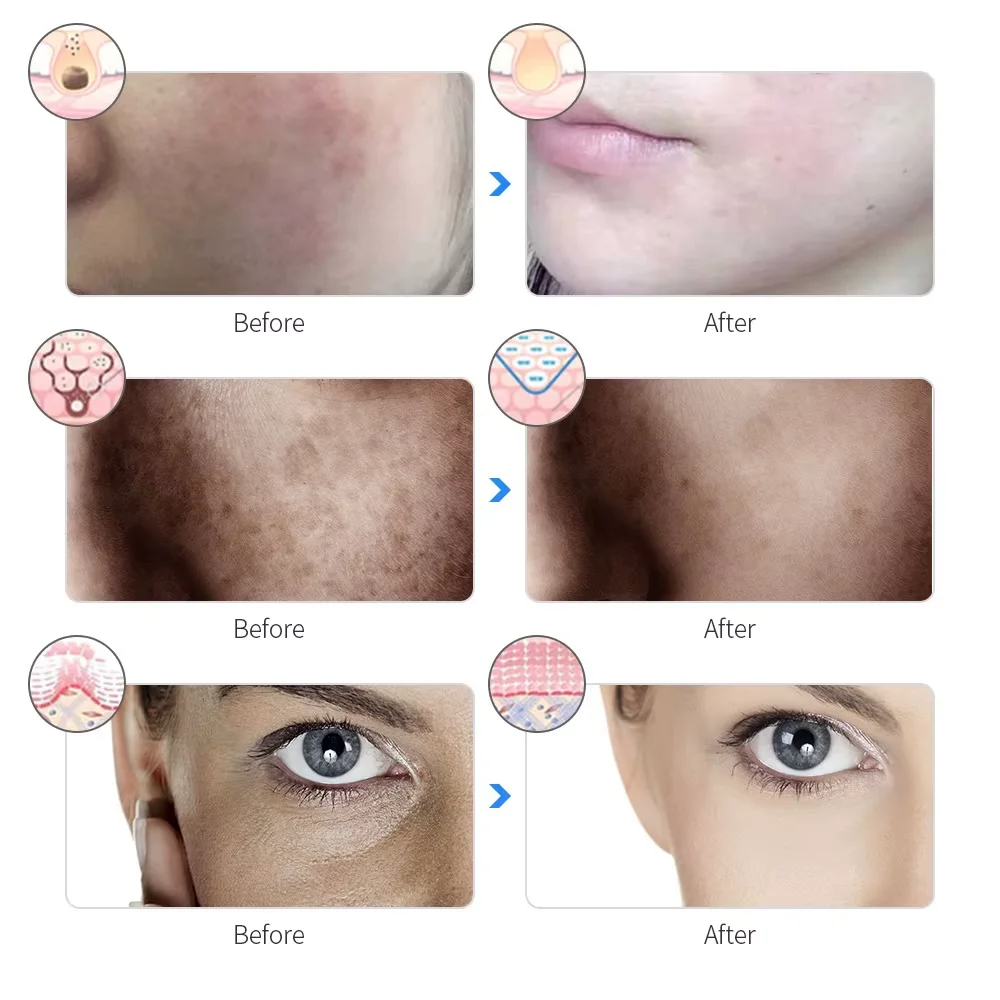 Máscara facial led de 7 cores, recarregável, terapia de fótons pdt, endurecimento e clareamento da pele, máquina facial de beleza, luz de tratamento pdt