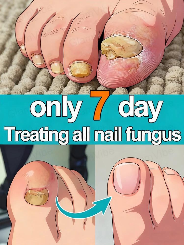 

Tʀᴇᴀᴛᴍᴇɴᴛ ᴏғ ᴏɴʏᴄʜᴏᴍʏᴄᴏsɪs (ғᴜɴɢᴀʟ ɪɴғᴇᴄᴛɪᴏɴ ᴏғ ᴛʜᴇ ɴᴀɪʟs).