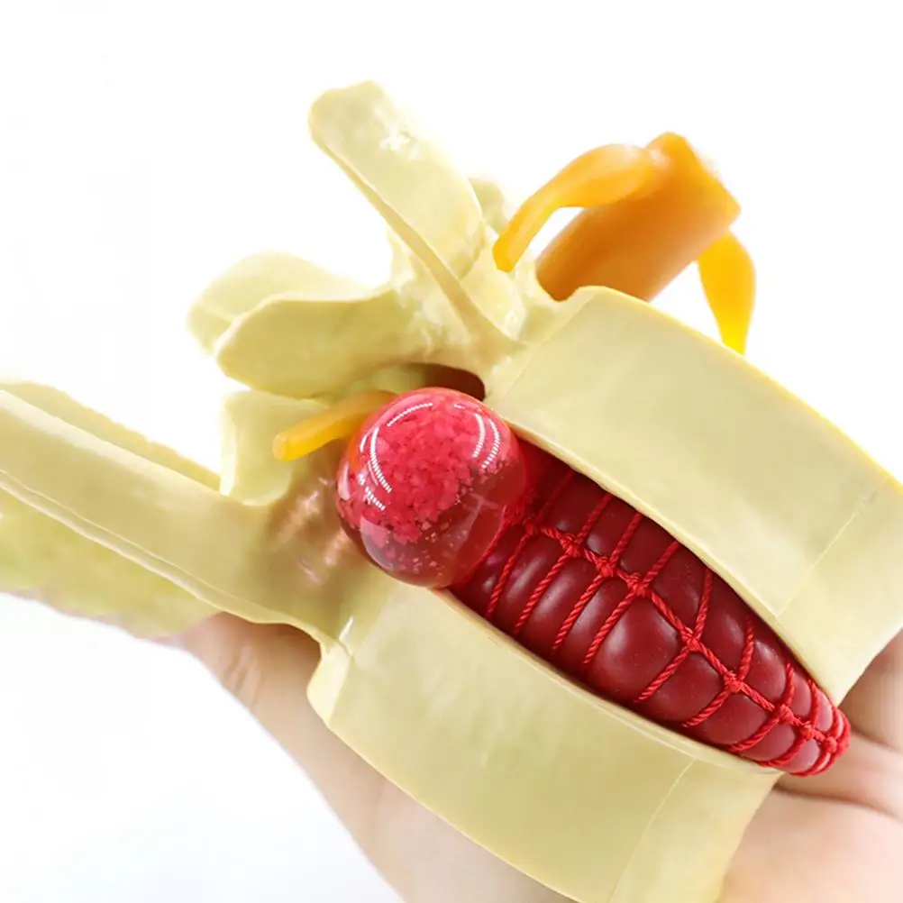 PVC Lumbar Disc Herniation Spine Model Realistic Shape Portable Perfect Teaching Demonstrating Human Anatomy Medical