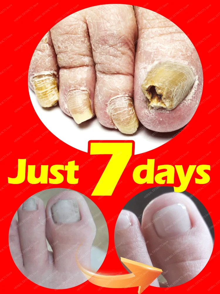 

NewToenail Nail Fungus Treatment Repair Fingernail Device Toenail Treatment for Foot Nail Fungus Essential Onychomycosis Ca