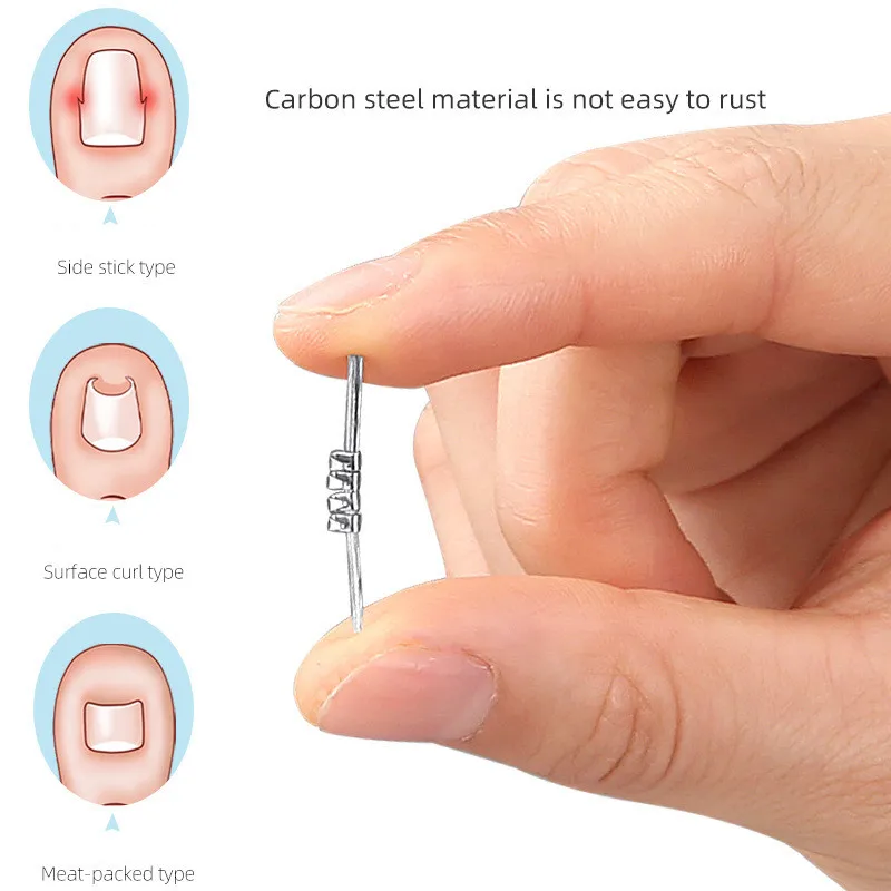 Ingrown Toenail Correction Nail Care Ingrown Toenail Straightening Clip Brace Pedicure Tool Wearable Foot Correction Clip Buckle