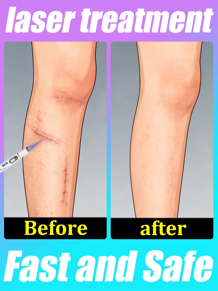 Generazione di cicatrici migliorate riparazione cicatrici radice uickly 1a
