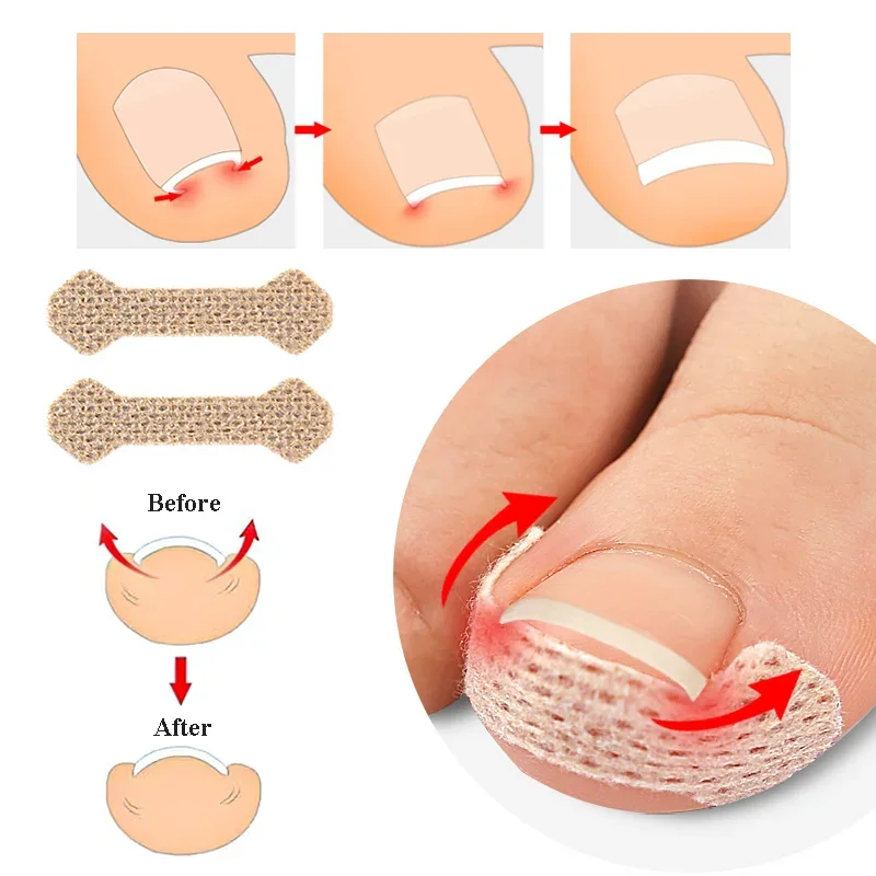 10/40pcs Nail Correction Stickers Ingrown Toenail Corrector Patches Treatment Manicure Recover Corrector Pedicure Care Tool