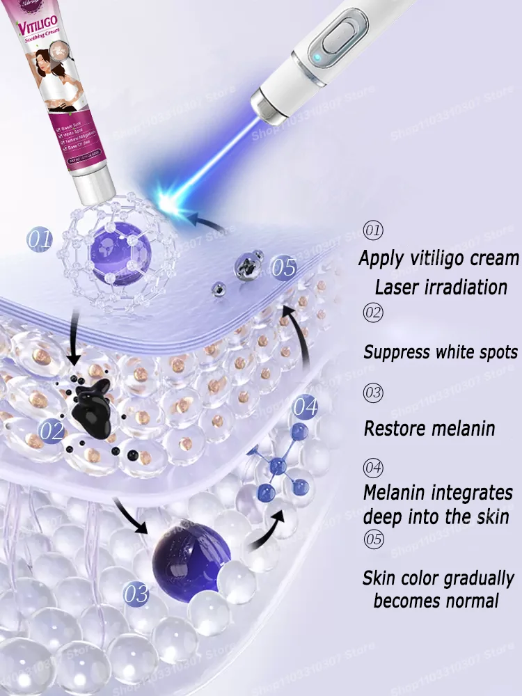 Vitiligo Pen Blue Light Laser