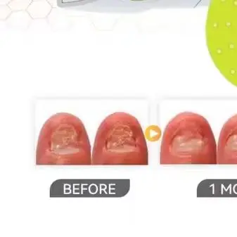 

Effective Anti-Fungal Laser Device for Nails, Painless for Thick Discolored Toenails Onychomycosis Repair