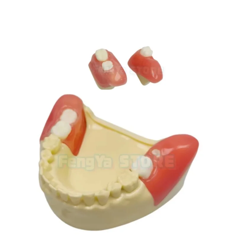1 Pcs Dental Impacted Wisdom Tooth Extraction Practice Model Replaceable lump Oral Practice Teaching Model