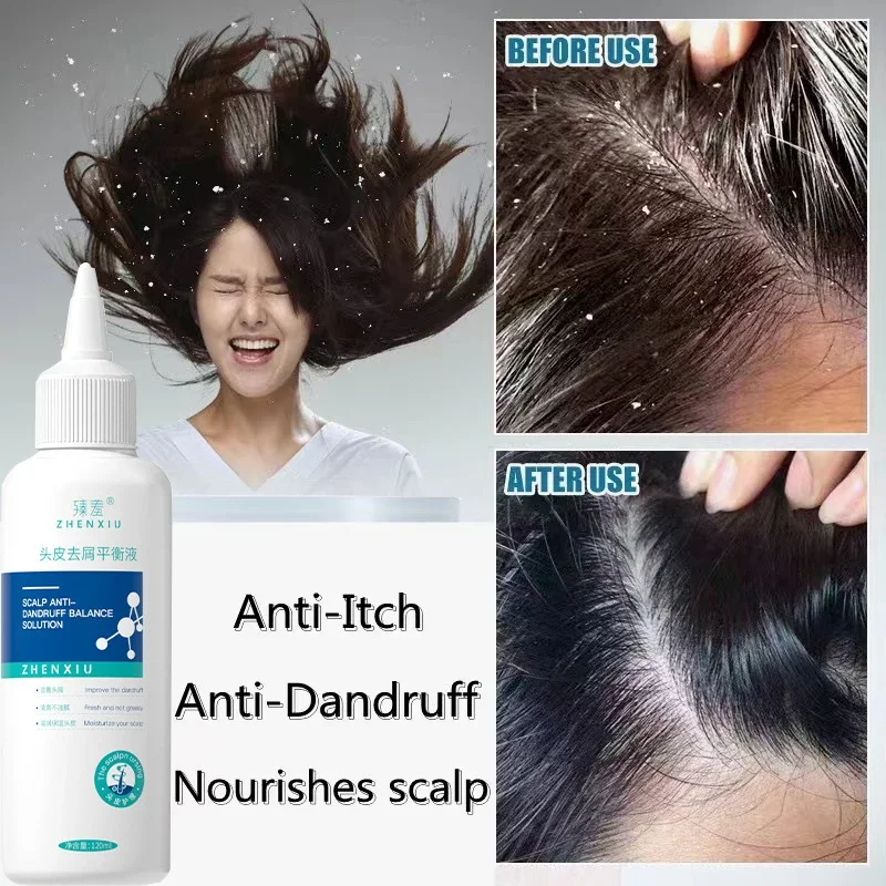 2 pcs Anti-Dandruff Shampoo Lice Mites Remover Shampoo Scalp Follicle Dissolve Oil Antipruritic Anti Hair Loss Treatment