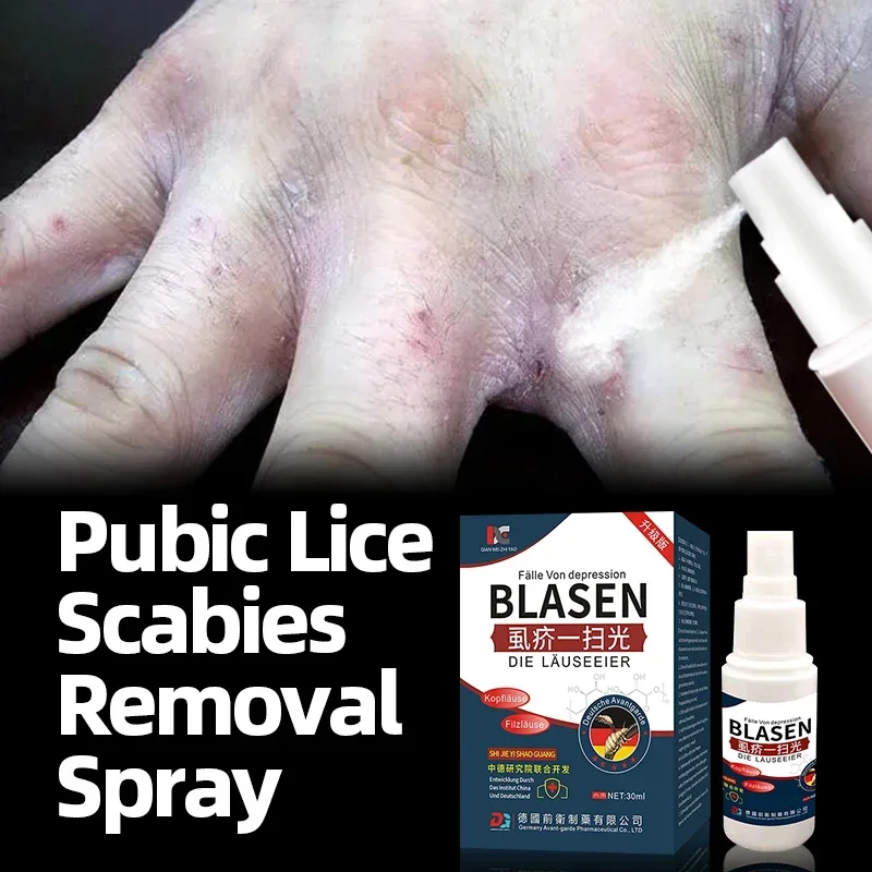 Pubic Lice Treatment Scabies Spray Mites Removal Medicine Head Lice Eggs Remover Antibacterial Anti-Itching German Secret Recipe