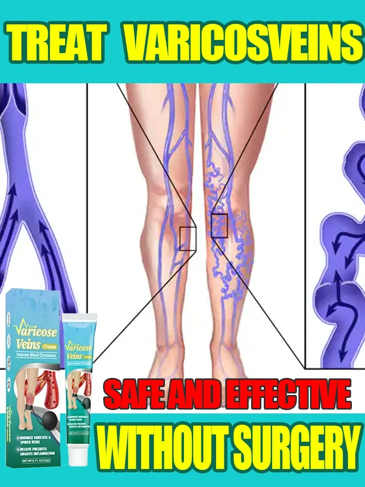 

Varicose Vein Treatment Effective Natural Ingredient Varicose Vein Relief Relief from Vasculitis Phlebitis Spider Pain Treatment