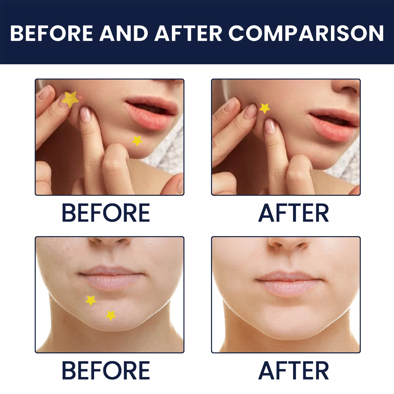 Patchs hydrocolloïdes imperméables pour l'acné, miroir Invisible 2 en 1 pour le nettoyage et le soin du visage, outil d'essence adapté à tous les Types de peau