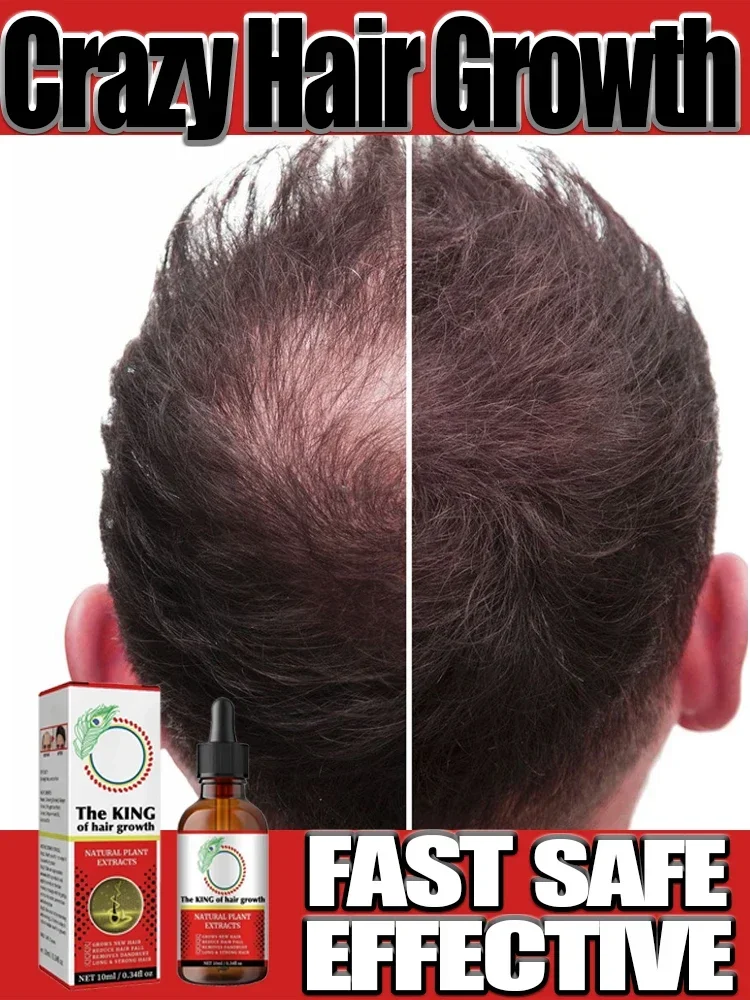 Nourish and care for male and female ahair Repair Treatment with growth ahair Thinning Seborrheic Alopecia Treatment Hair