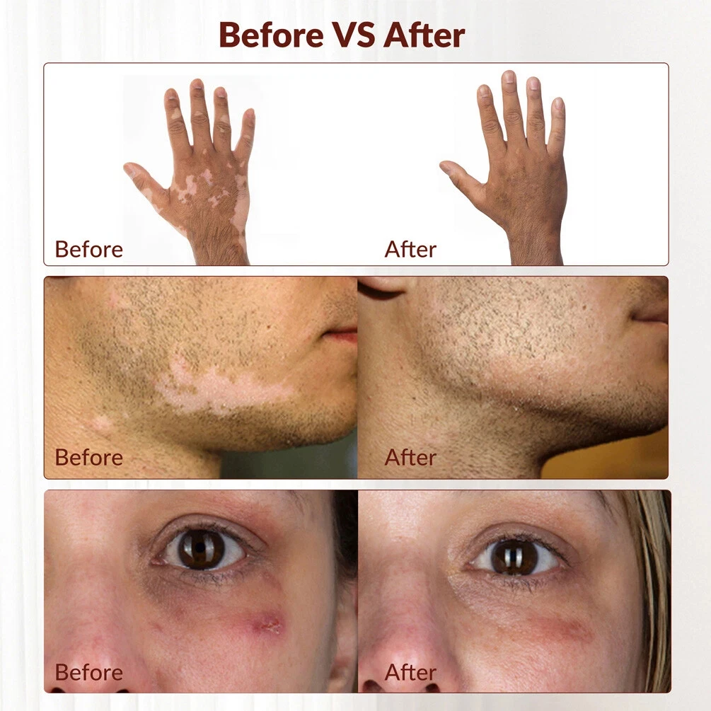 Instrumento de terapia de banda estrecha UVB de 311nm, lámpara de fototerapia UV para lámpara de terapia de Vitiligo, tratamiento de enfermedades de la piel de la Psoriasis en el hogar