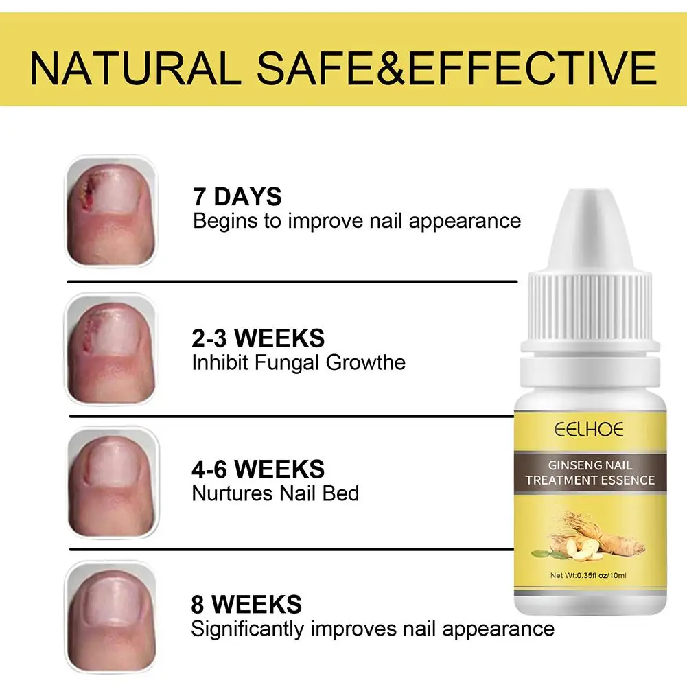 Nail Fungus Removal Cream Onychomycosis Fungal Nail Ointment Paronychia Fungal Nail Infection Anti Treatment Toe Care Feet P3N7