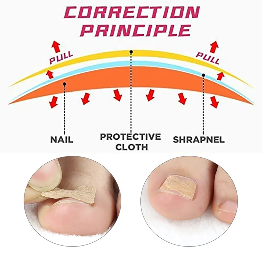 Pexmen 100/200/500/1000Pcs Ingrown Toenail Treatment No Glue Breathable Corrector Patch Painless ingrown toenail corrector