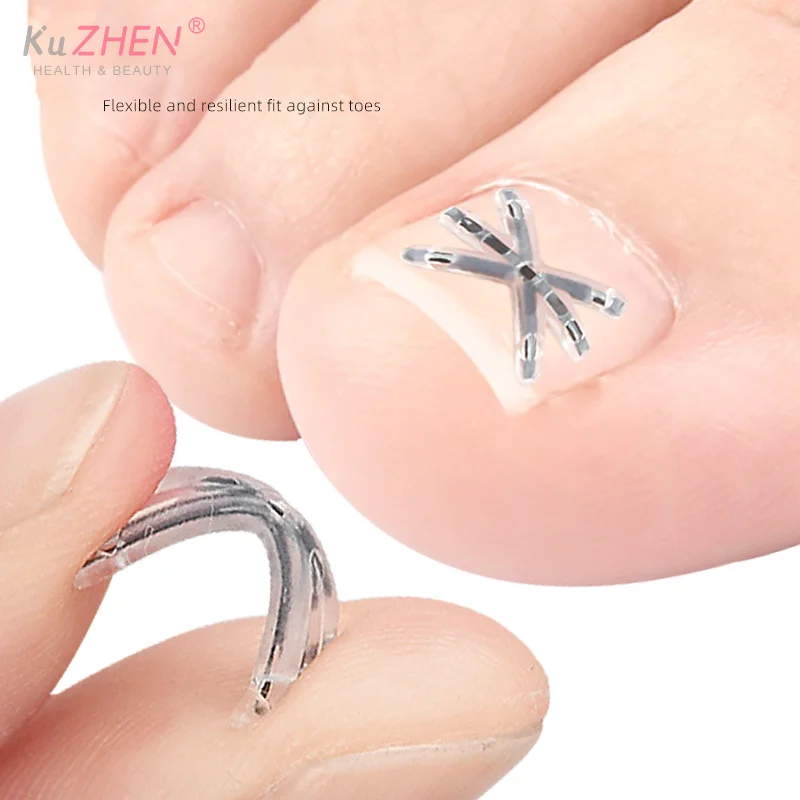 2Pc 13/17MM Ingrown Toenail Correction Tool Ingrown Toenail Treatments Elastic Patch Sticker Toenail Straightening Pedicure Tool