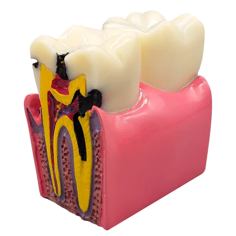 8 Times Dental Caries Model Disease Teeth Dental Model for Dental Demonstration Model Dentist Teaching Dental Lab Oral Research