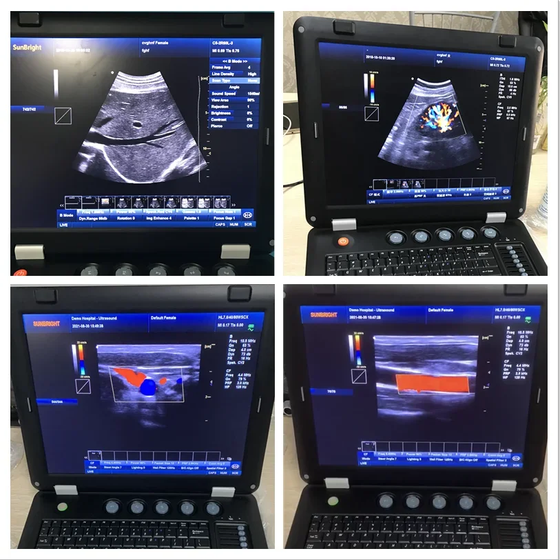 Factory price human portable 3d colour doppler ultrasound scanner machine sonography