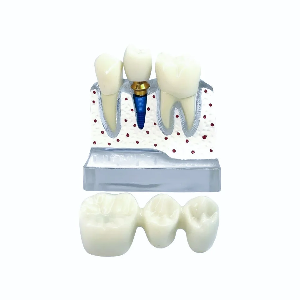 Clear Acrylic Dental Implant Pathology Model Detachable Bridge Abutment Screw for Student Training Patient CommunicationTeaching