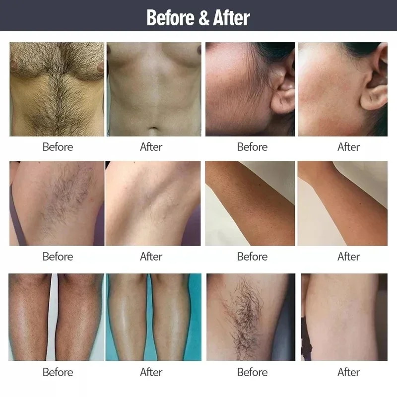 2024 4000w 2 in1 755 808 1064nm diodo laser permanente portátil picosegundo laser tatuagem remoção e depilação máquina comutada