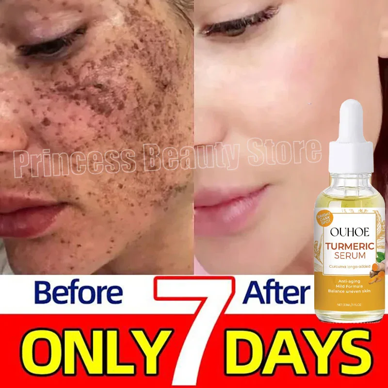 Turmeric Freckle Whitening Serum Fade Dark Spots Removal Pigment Melanin Correcting Facial Beauty Products Skin Care Cosmetics