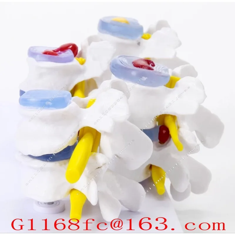 Four Stage Pathology Human Lumbar Model Intervertebral Disc Herniation Demonstration Model Medical Teaching Support
