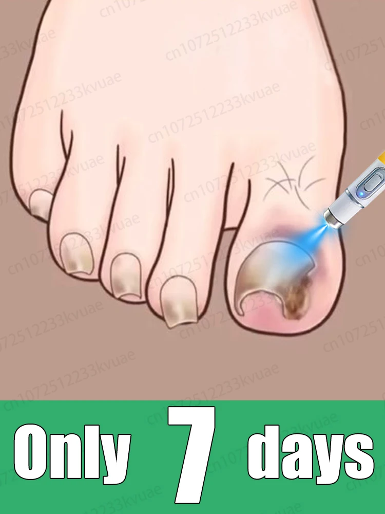 

Say goodbye to onychomycosis with scientific methods