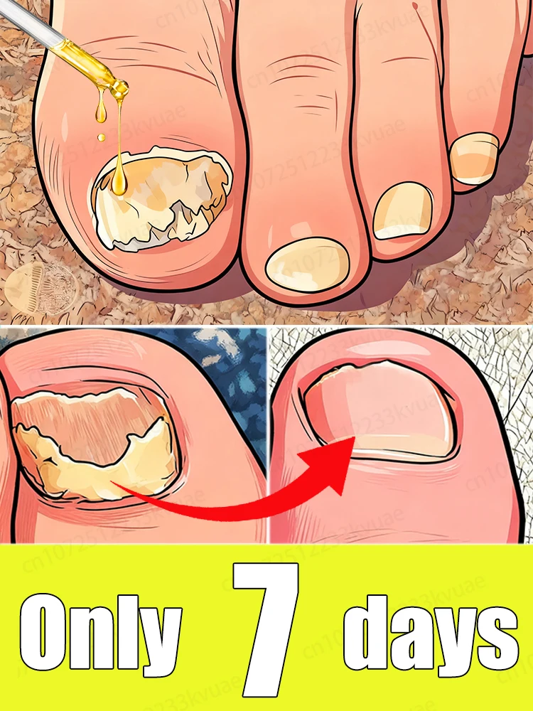 

Say goodbye to onychomycosis and don't let it affect your life.