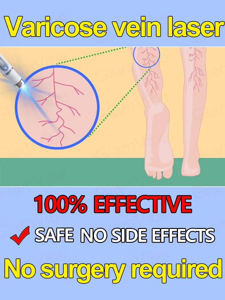 

Varicose vein laser eliminates vasculitis and phlebitis, relieves spider leg pain