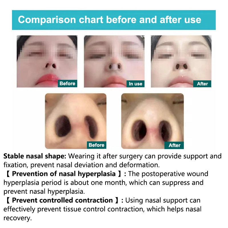 Soporte de fosa nasal de rinoplastia postoperatoria, moldeador de silicona, fijador de corrección de nariz torcida, Clip de Nariz de Gel de sílice