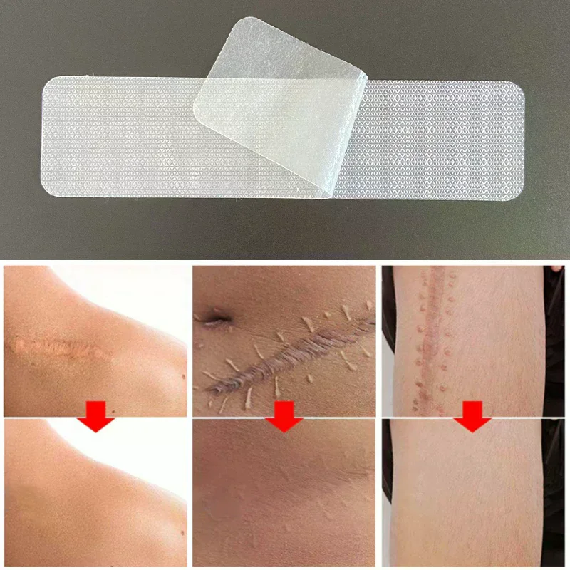 4x15cm Scar Patches Remove Silicone Gel Sheet Patch Ear Correctors Burn Wounds Efficient Surgery Tape Skin Repair Accessory