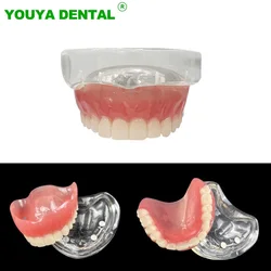 Implant dentystyczny Model zębów stomatologia górna Overdenture zdejmowany most 4 implanty przywrócenie demonstracja Model badanie naucz