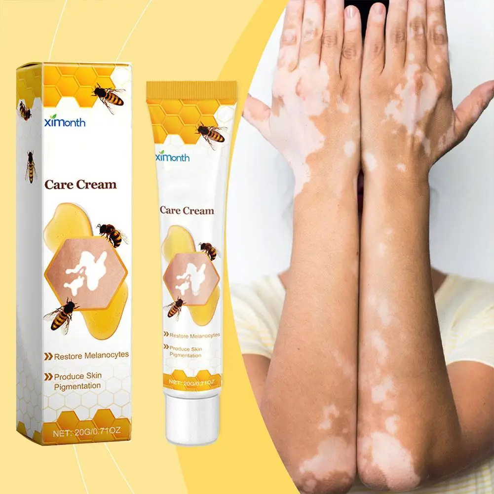 Crema de tratamiento de Vitiligo para reparación de abejas, cuidado de la piel, promueve la producción, inhibe las manchas blancas, alivia la propagación, crema de tratamiento