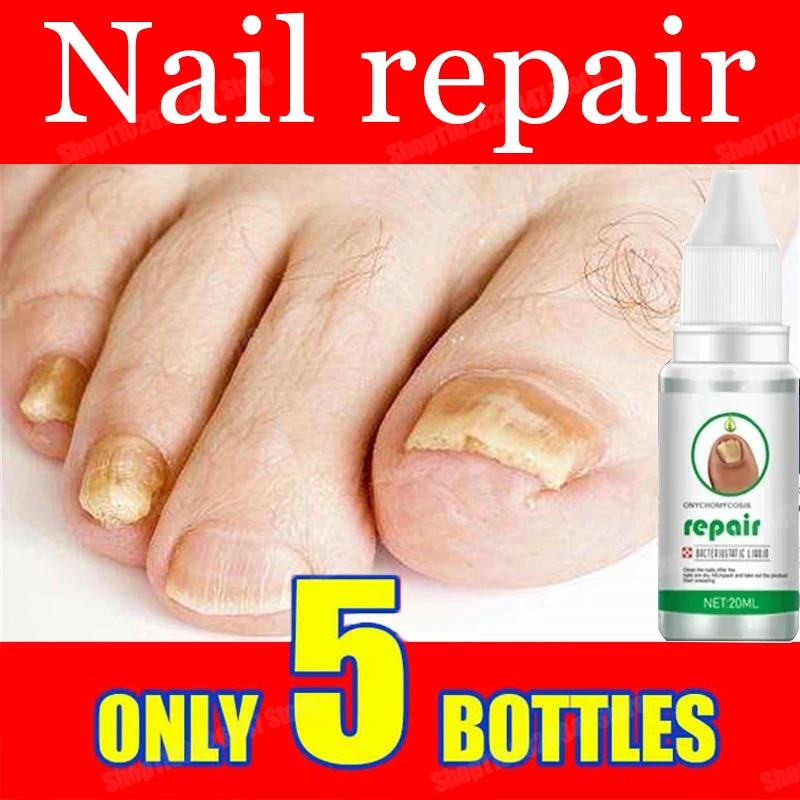 Nail Fungals Renewal Nail Repair Liquid for Discolored Thickened Crumbled Nails Nail Fungals for Discolored Broken Cracked 77