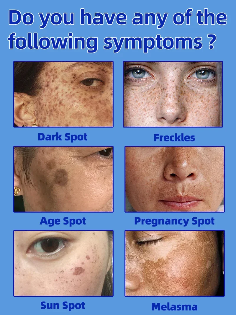 Freckles Melasma Chloasma Dark Spot