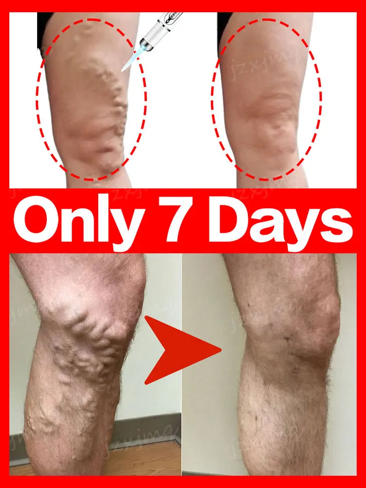 

Laser Therapy Varicose Veins Relieves Pain Improves Circulation