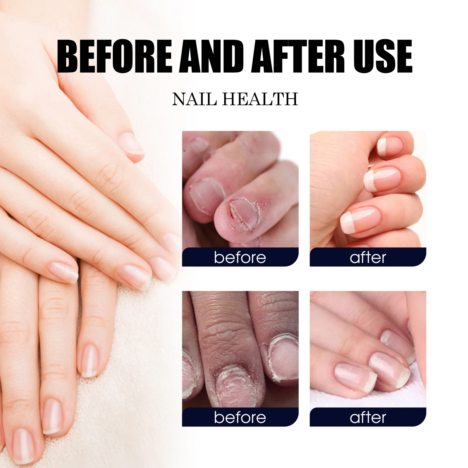 Fungal Nail Repair Drops Infection Nail Removal Anti Paronychia Improve Broken Cracked Discolored Toenail Renewal Care Essence