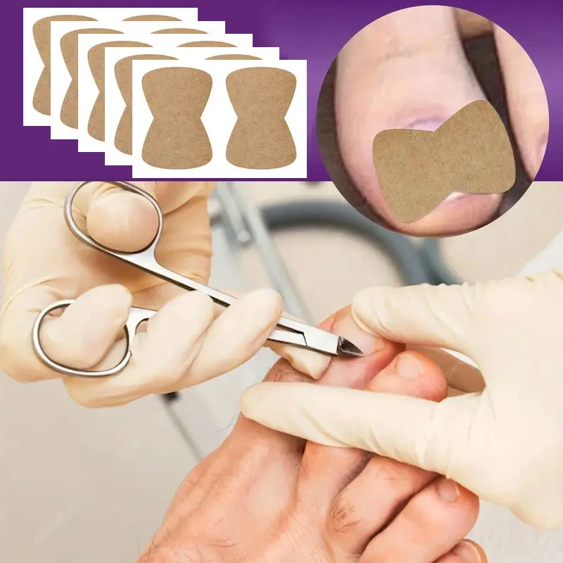 40/50/60/70 peças remendos multiuso para unhas dos pés, adesivos para unhas encravadas, kit de ferramentas profissionais para pedicure