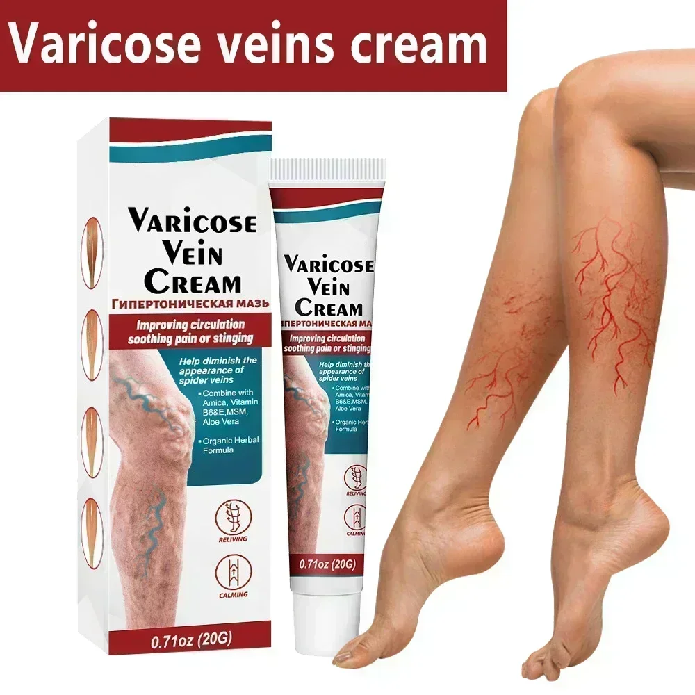 Varicose Veins Treatment Cream Angiitis Legs Dilated Relief Vasculitis Phlebitis Spider Leg Varicosity Foot Care Medicine