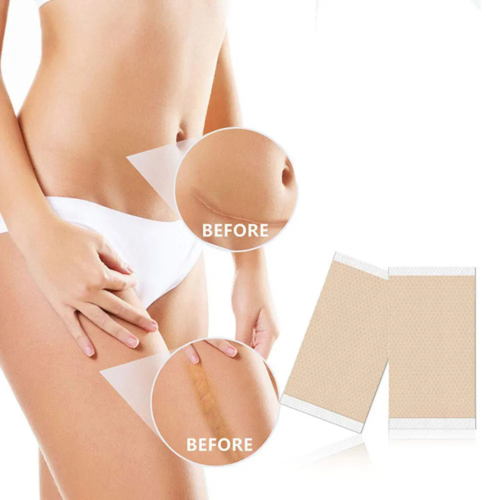 4 سنتيمتر * 50 سنتيمتر ندبة ورقة إزالة قطاع الطفل الأذن مصحح هلام السيليكون ندبة التصحيح قطاع لحب الشباب كيلويد جراحة حرق العلاج #3