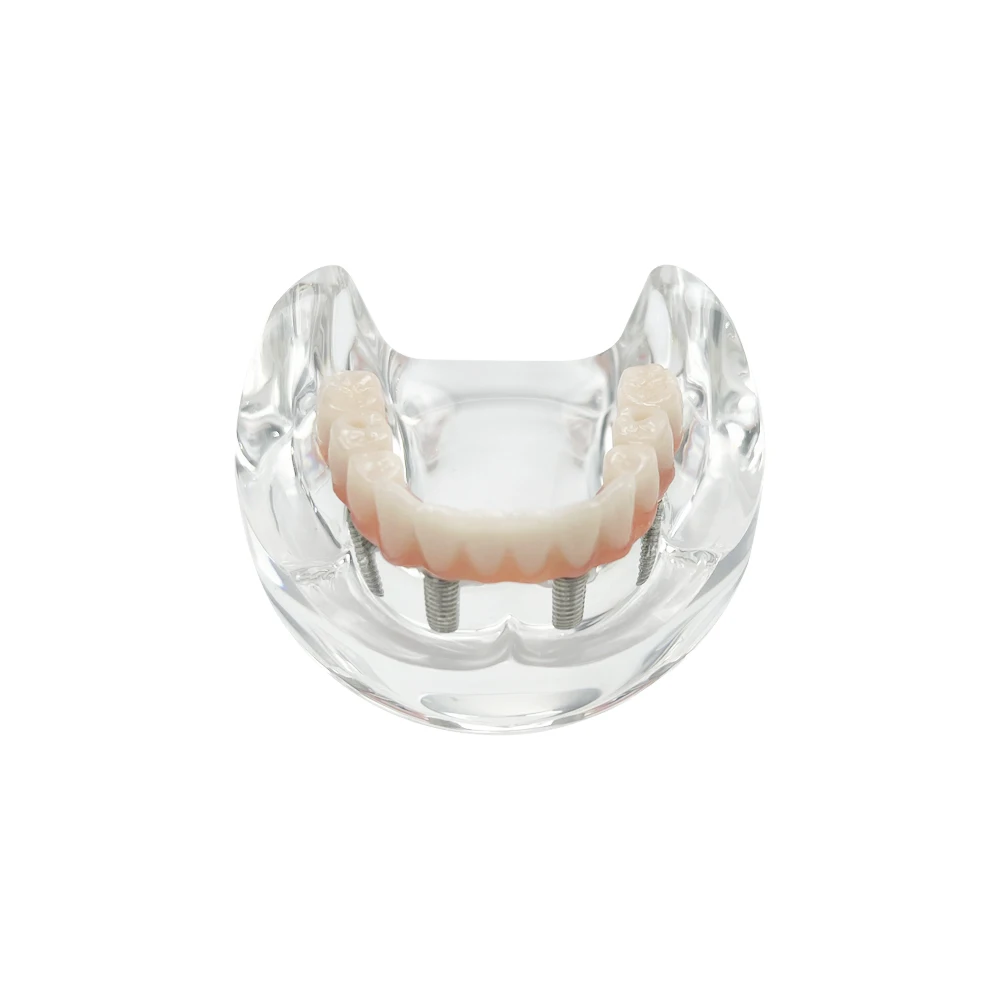 Lower Jaw Implant Model For Education Teaching Mandible Dental Overdenture Teeth Model With 4 Implants Removable Screws Typodont