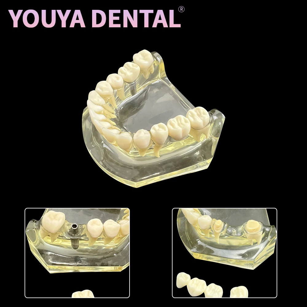 

Dental Transparent Mandibular Implant Model Removable Tooth Restoration Tooth Typodont Tooth Model For Dentist Teaching Training